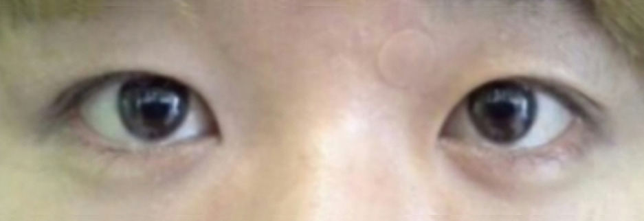 After: Men's incisional ptosis correction, two months after surgery