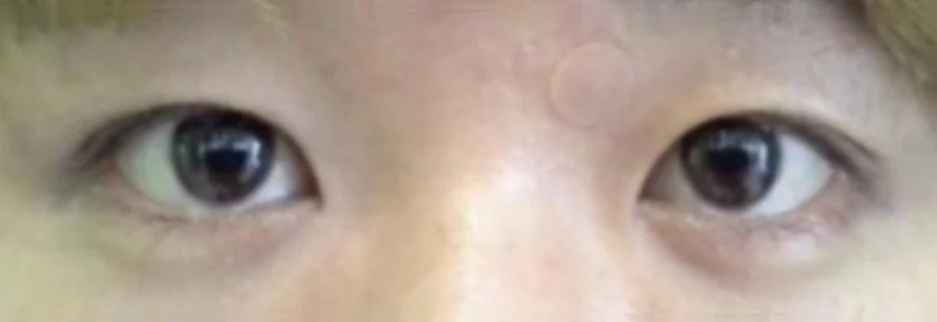 After: Men's incisional ptosis correction, two months after surgery