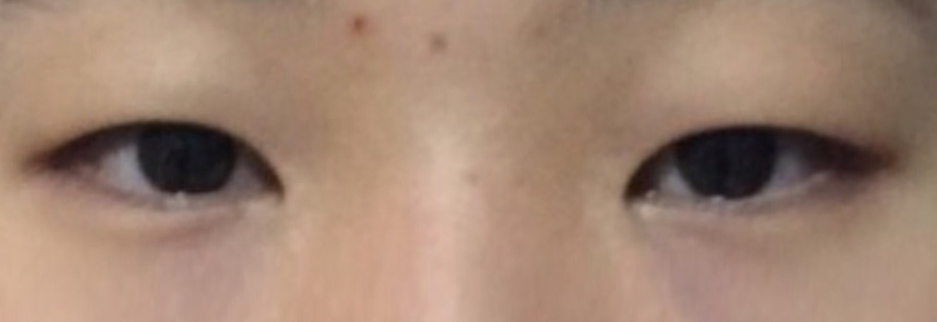 Before: Incisional ptosis correction with lateral canthoplasty, three weeks after surgery