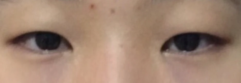Before: Incisional double eyelid surgery with ptosis correction, three weeks after surgery