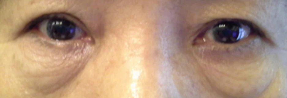 Before: Lower blepharoplasty for a woman in her 60s, two weeks after surgery