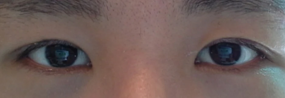 After: Men's incisional ptosis correction, two months after surgery