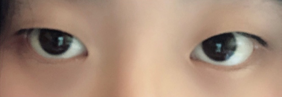 Before: Incisional ptosis correction with lateral canthoplasty, one month after surgery