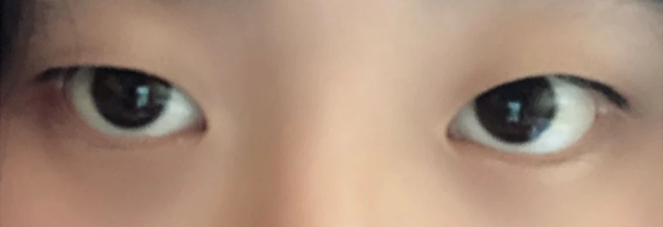 Before: Incisional double eyelid surgery with ptosis correction, one month after surgery