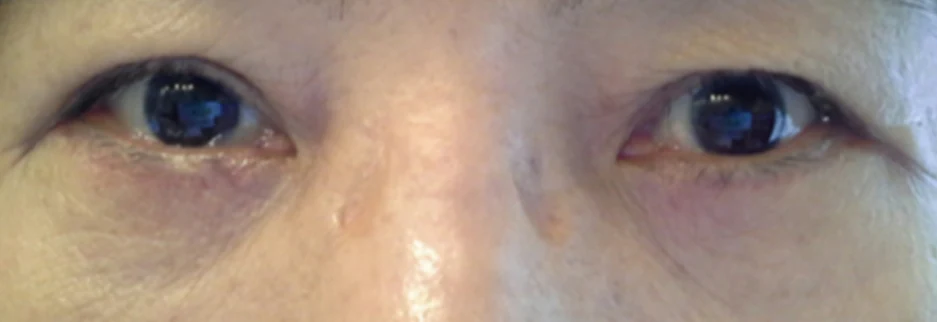 After: Lower blepharoplasty for a woman in her 60s, two weeks after surgery