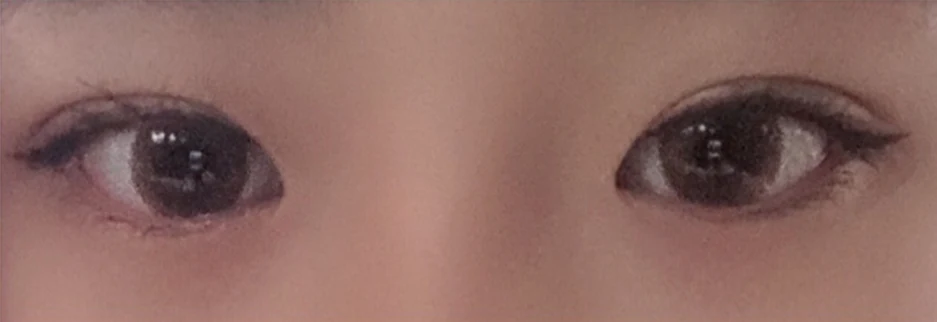 After: Incisional double eyelid surgery with ptosis correction, one month after surgery