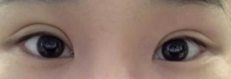 Before: Revision surgery to lower a high fold, two months after surgery