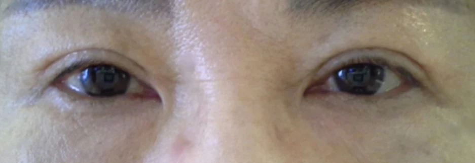 After: Upper blepharoplasty for a woman in her 60s, two months after surgery