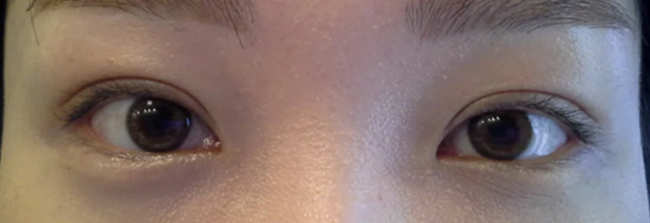 After: Revision surgery for asymmetric folds, one month after surgery