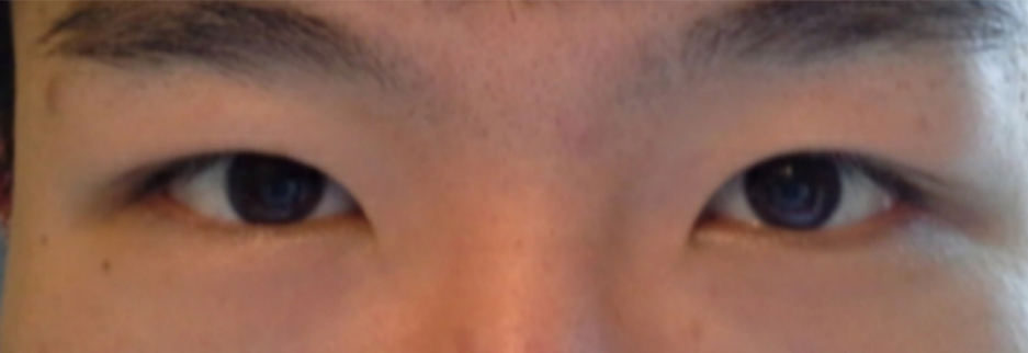 After: Men's incisional ptosis correction, two months after surgery