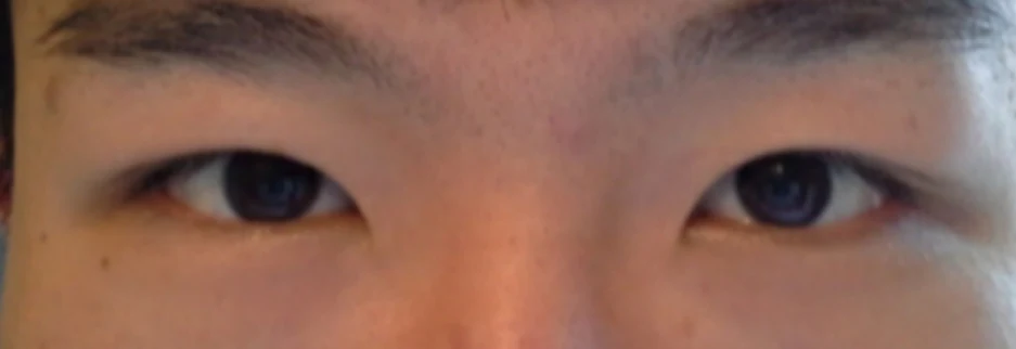 After: Men's incisional ptosis correction, two months after surgery