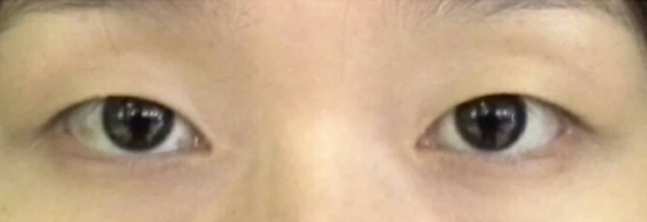 Before: Non incisional double eyelid with ptosis correction, two weeks after surgery