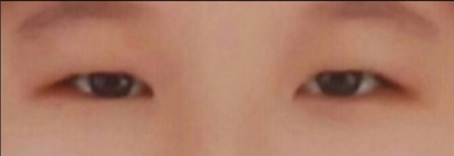 Before: Incisional ptosis correction, one month after surgery
