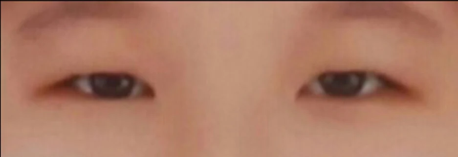 Before: Incisional ptosis correction, one month after surgery