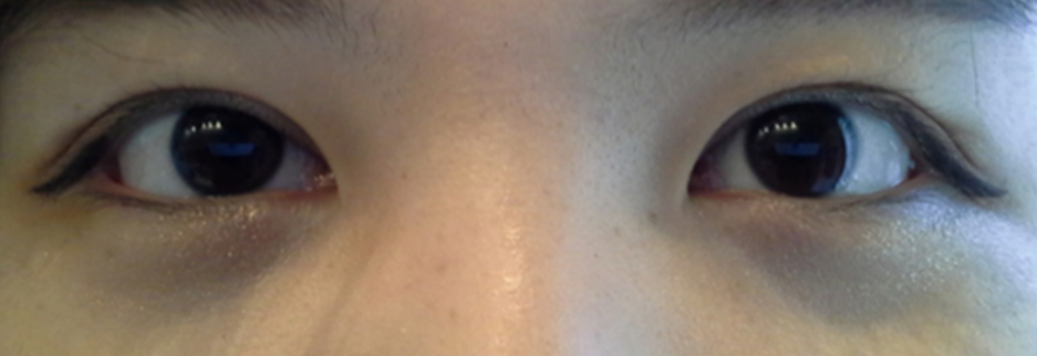 After: Revision surgery to lower a high fold, three months after surgery