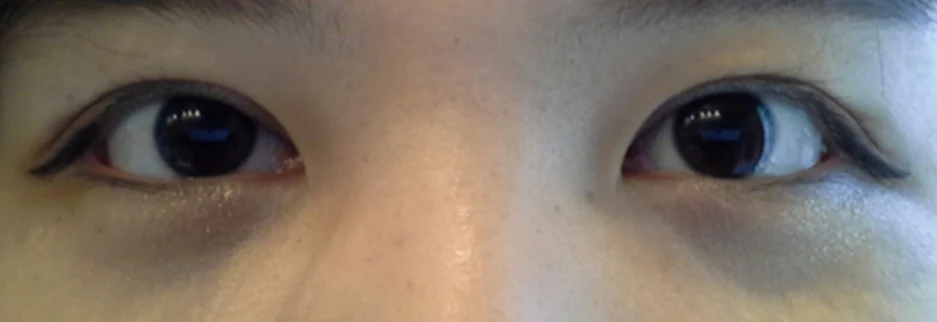 After: Revision surgery to lower a high fold, three months after surgery