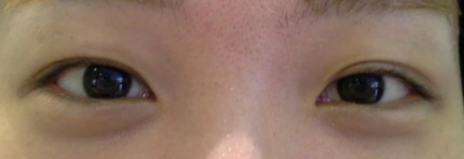 Before: Revision surgery for asymmetric folds, one month after surgery