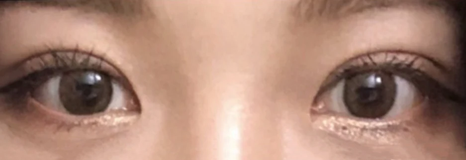 After: Incisional double eyelid surgery with ptosis correction, one month after surgery