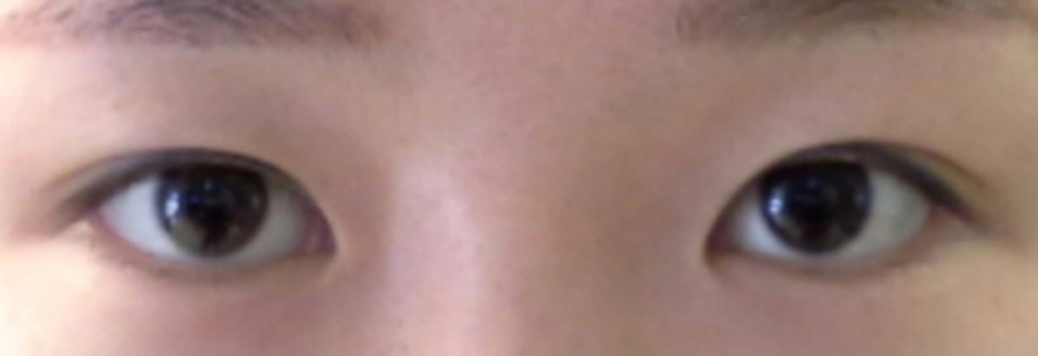 Before: Revision surgery for a loosened fold, three months after surgery