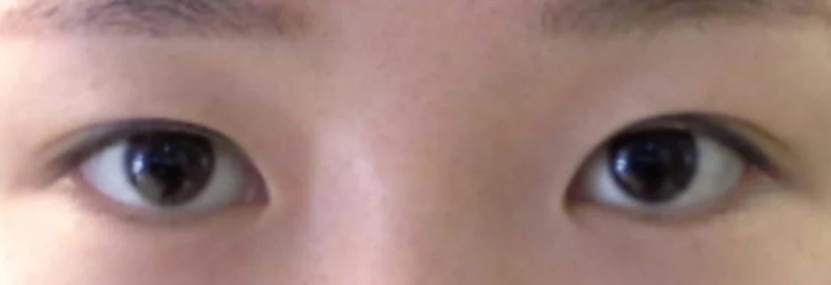 Before: Revision surgery for a loosened fold, three months after surgery