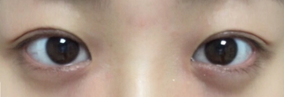 After: Incisional ptosis correction, one month after surgery
