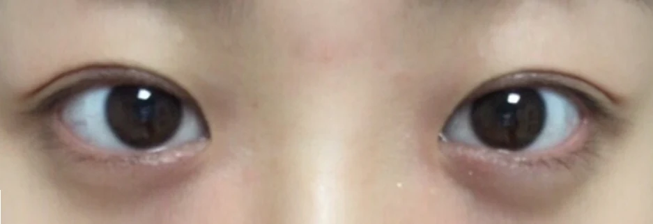 After: Incisional ptosis correction, one month after surgery