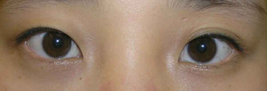 Before: Non incisional double eyelid with ptosis correction, two weeks after surgery
