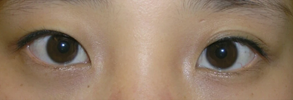 Before: Non incisional double eyelid with ptosis correction, two weeks after surgery