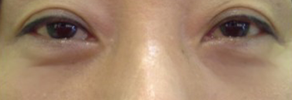 After: Under eye fat repositioning, one month after surgery