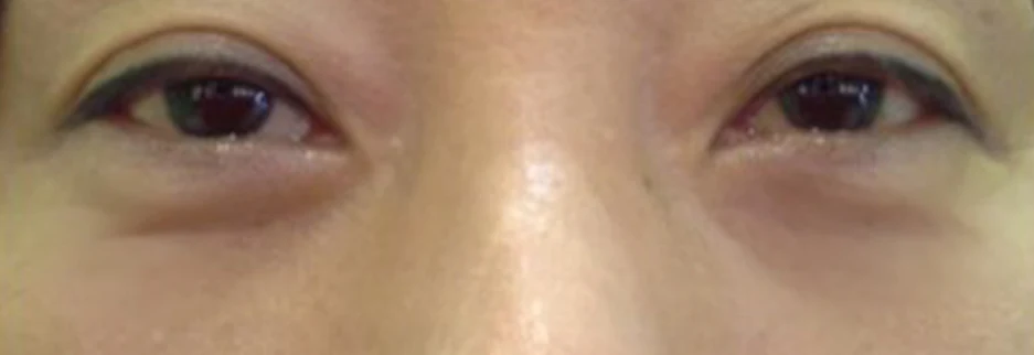 After: Under eye fat repositioning, one month after surgery