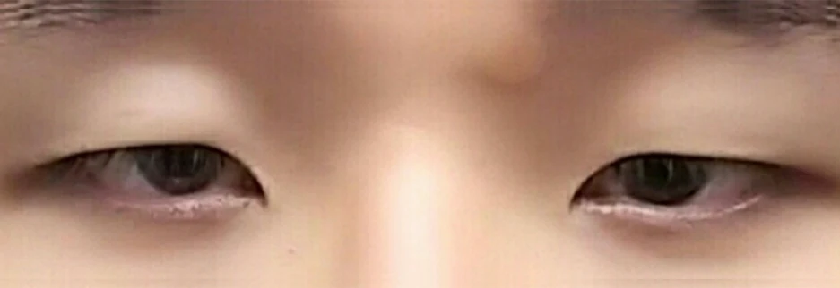 Before: Men's incisional ptosis correction, two months after surgery