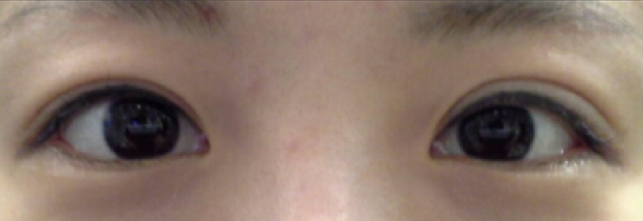 Before: Revision surgery for a loosened fold, two months after surgery