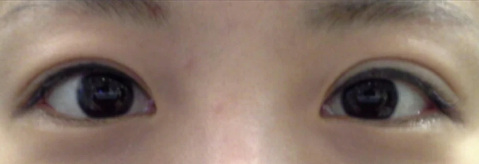 Before: Revision surgery for a loosened fold, two months after surgery