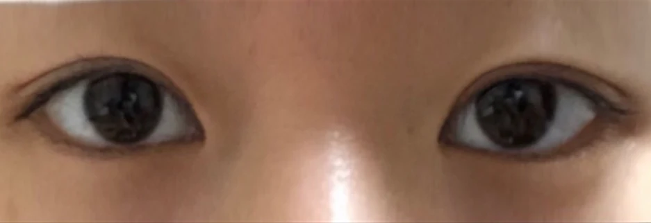 After: Incisional double eyelid surgery with ptosis correction, one month after surgery