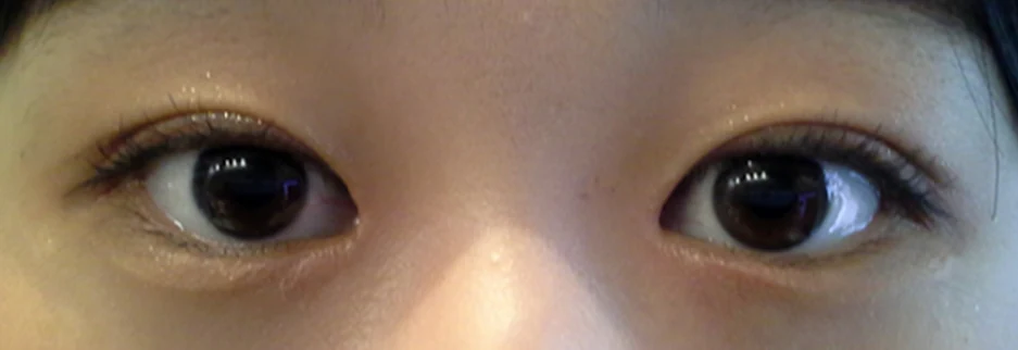 After: Epicanthoplasty, one month after surgery