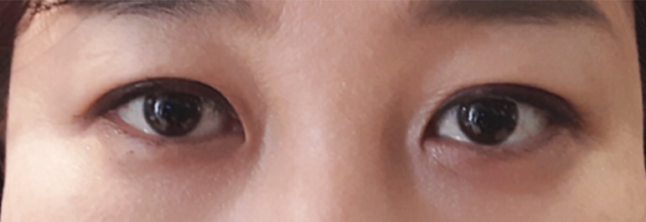 After: Upper blepharoplasty for a woman in her 40s, two months after surgery
