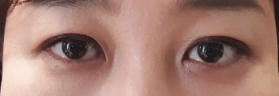 After: Upper blepharoplasty for a woman in her 40s, two months after surgery