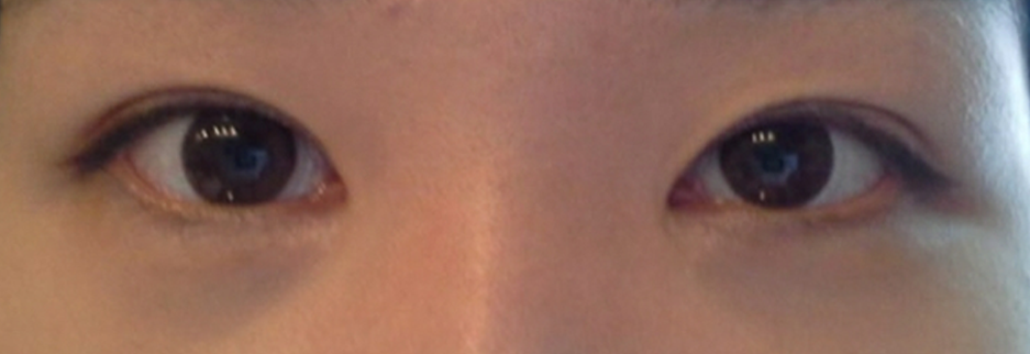 After: Revision surgery for a loosened fold, two months after surgery