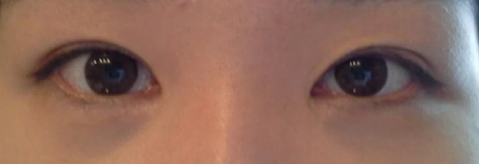 After: Revision surgery for a loosened fold, two months after surgery