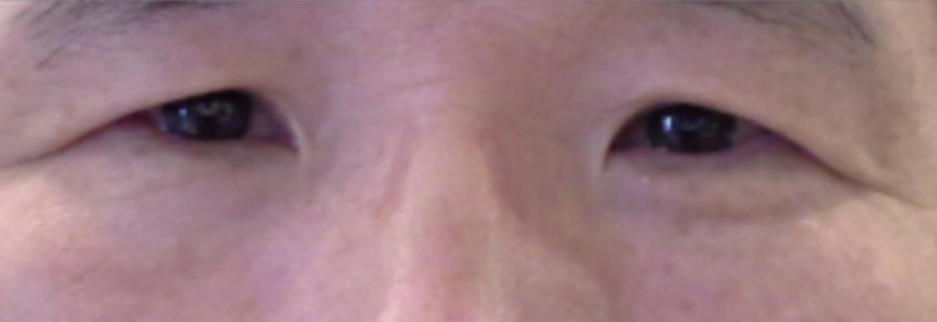 Before: Upper blepharoplasty for a man in his 50s, three months after surgery