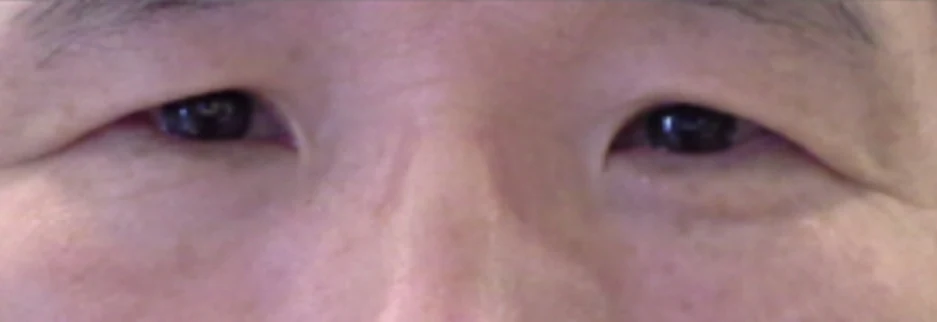 Before: Upper blepharoplasty for a man in his 50s, three months after surgery