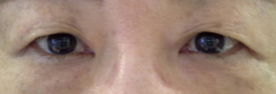 Before: Upper blepharoplasty for a woman in her 60s, two months after surgery
