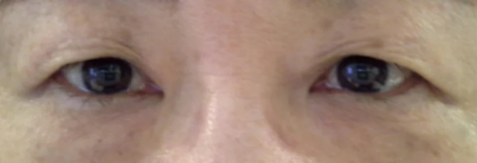 Before: Upper blepharoplasty for a woman in her 60s, two months after surgery