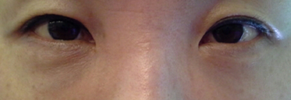 After: Under eye fat repositioning, one month after surgery