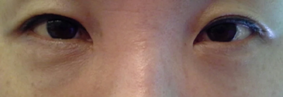 After: Under eye fat repositioning, one month after surgery