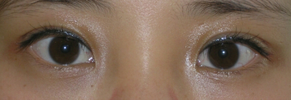 After: Non incisional double eyelid with ptosis correction, two weeks after surgery