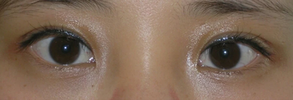 After: Non incisional double eyelid with ptosis correction, two weeks after surgery
