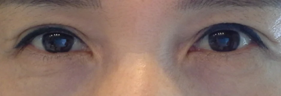After: Upper blepharoplasty for a woman in her 50s, three months after surgery
