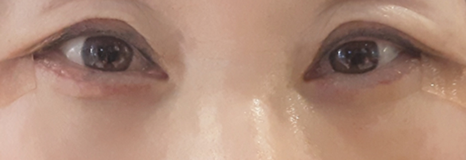 After: Lower blepharoplasty for a woman in her 60s, four days after surgery