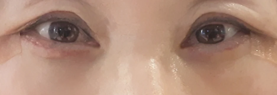 After: Lower blepharoplasty for a woman in her 60s, four days after surgery